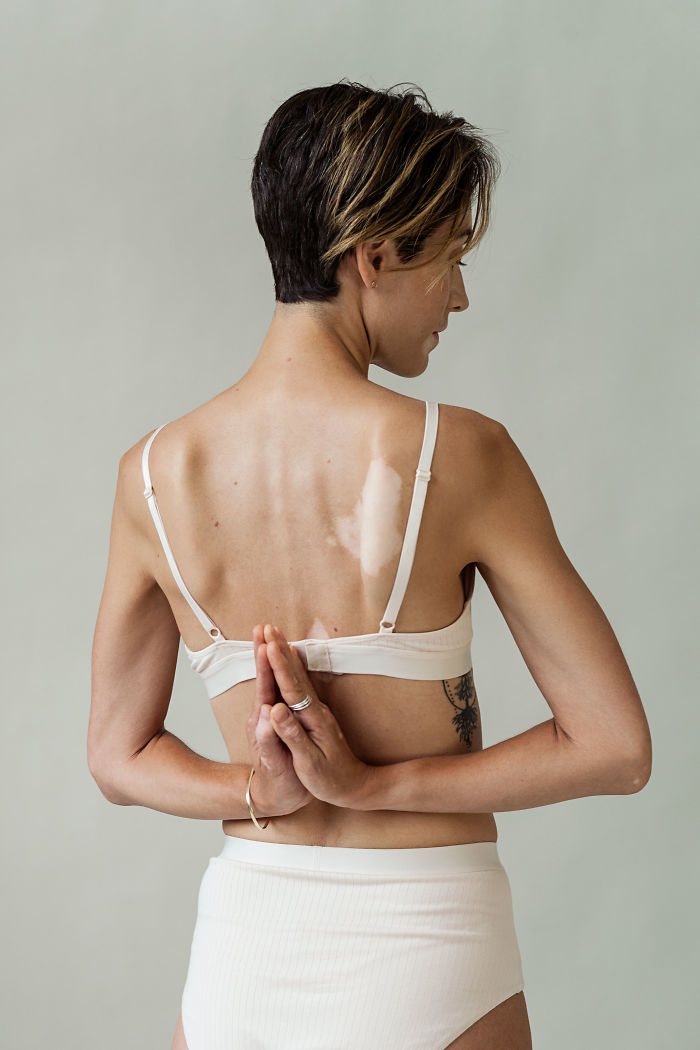 La apariencia única de las mujeres con vitiligo.