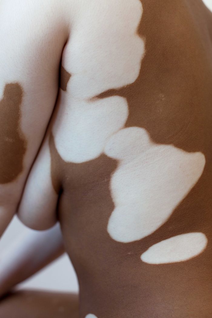 Características del cuerpo con vitiligo