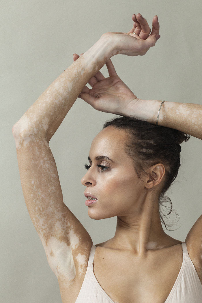 Manchas de vitiligo na pele