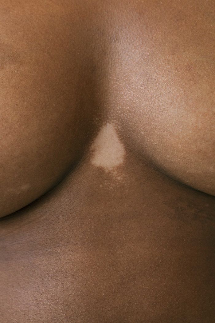 Mancha de vitiligo