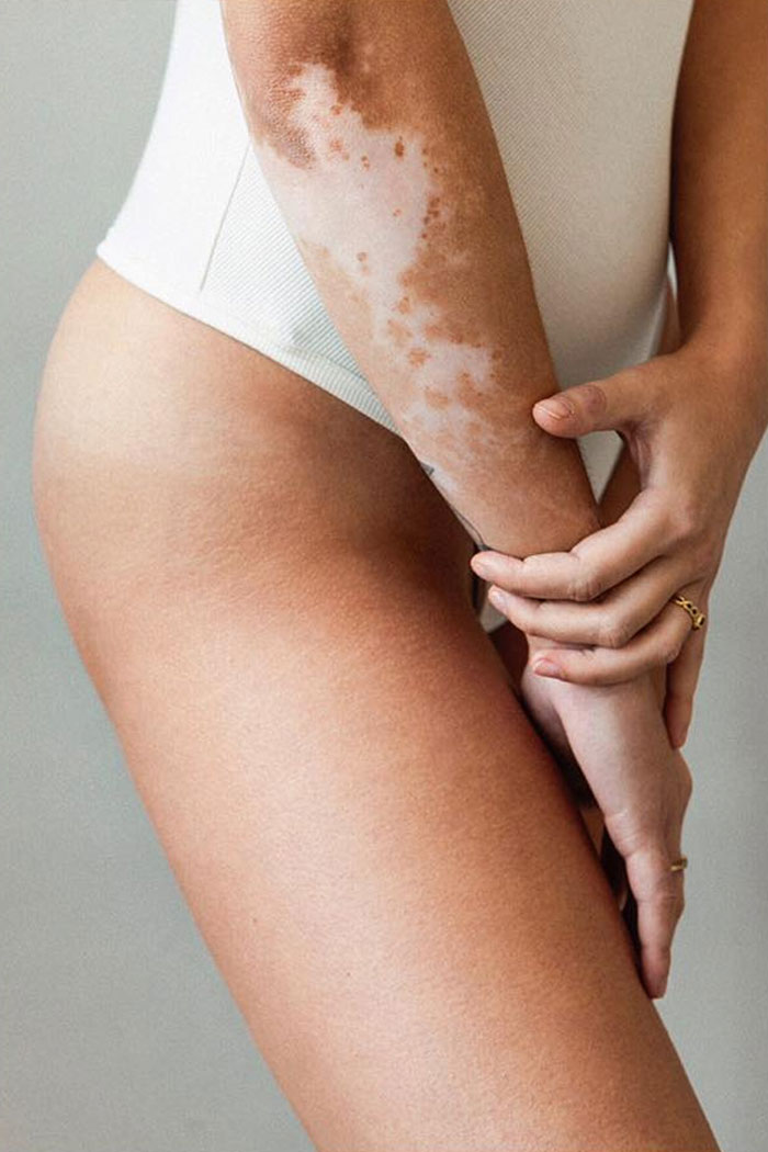 Manchas de vitiligo no braço