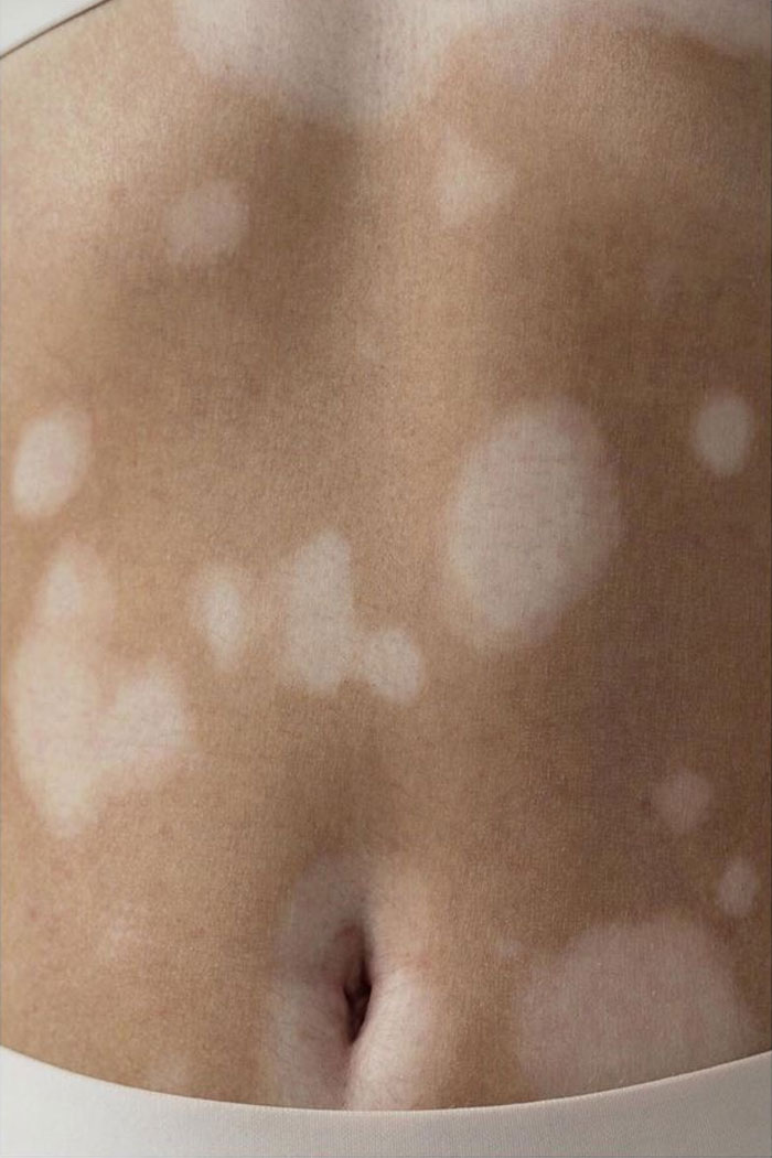 La apariencia única de las niñas con vitiligo.