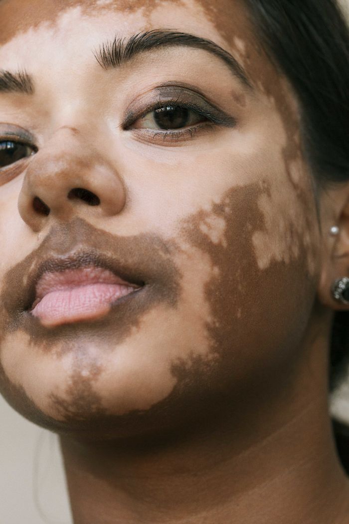 Mujer con vitiligo