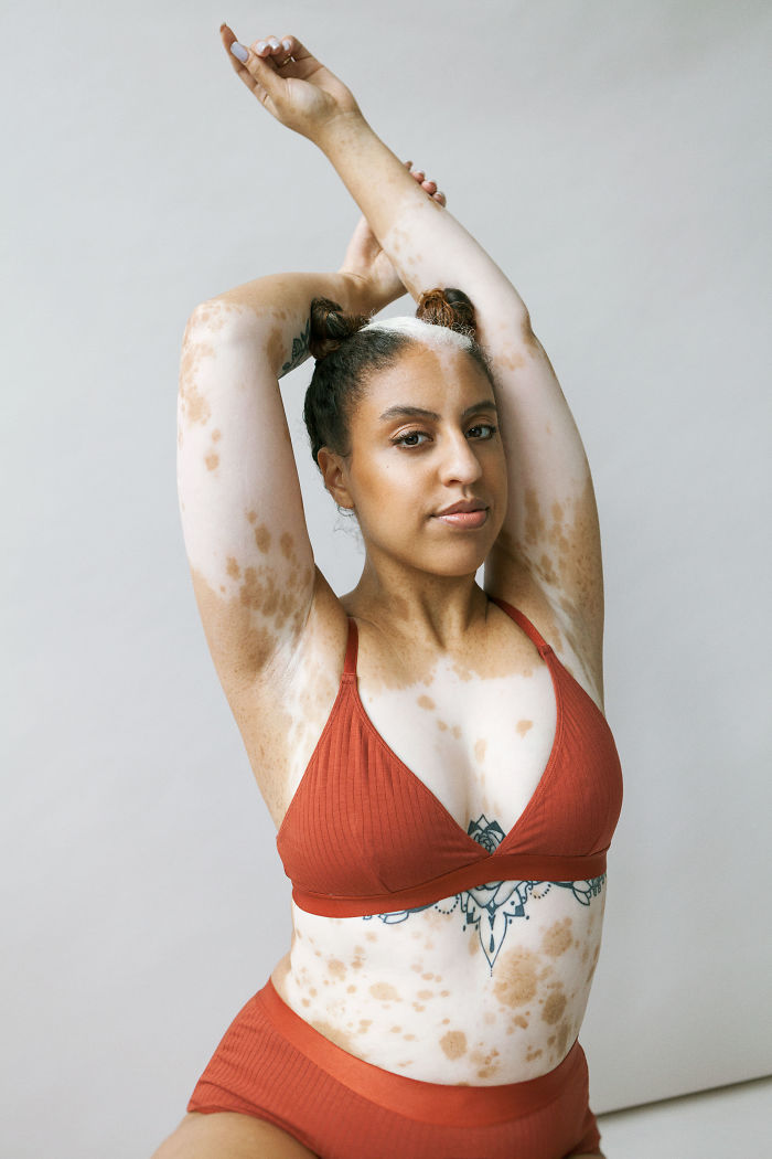 Bella mujer con vitiligo