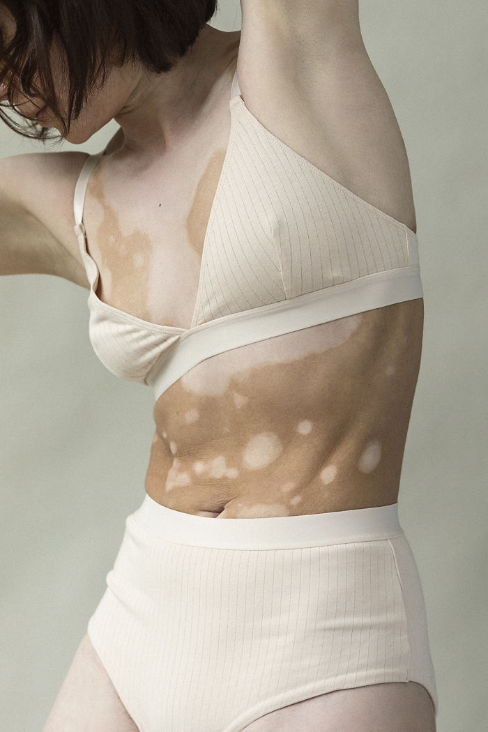 Las modelos femeninas no son tímidas con respecto al vitiligo