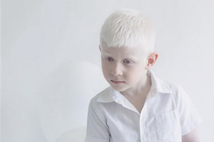 A white albino