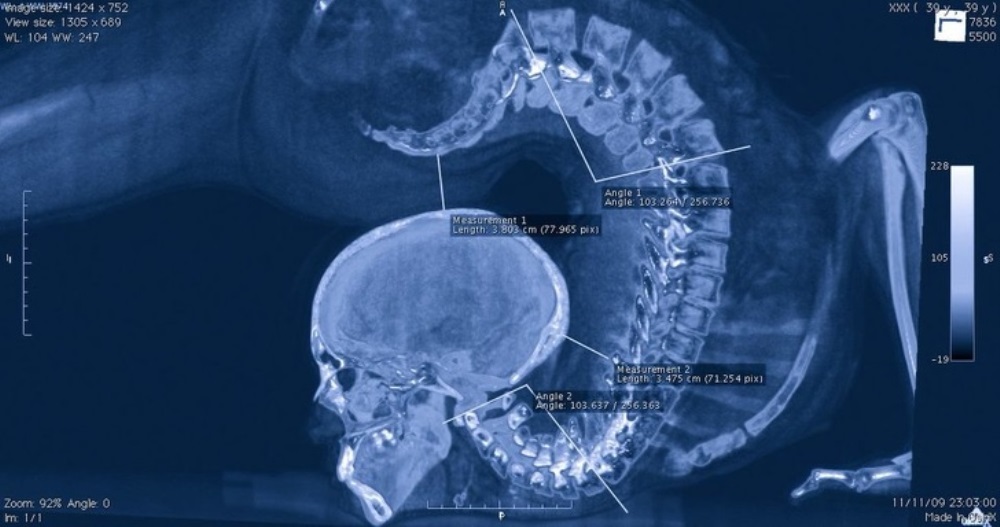 Η σπονδυλική στήλη ενός ανθρώπου-λάστιχο που στηρίζεται στο κεφάλι του