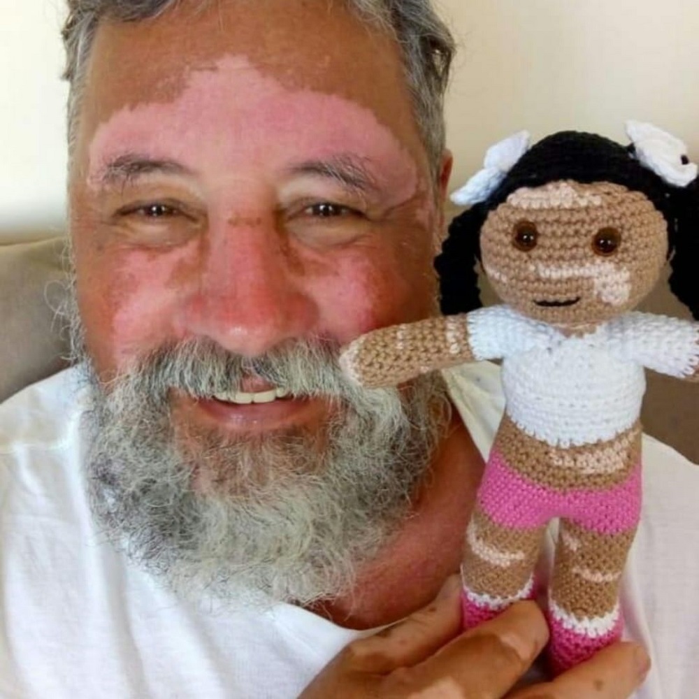 bonecas com vitiligo e um homem