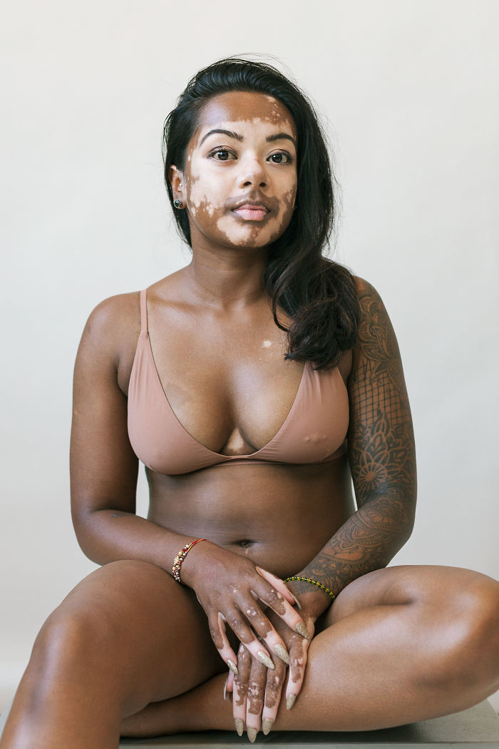 Mulher com vitiligo